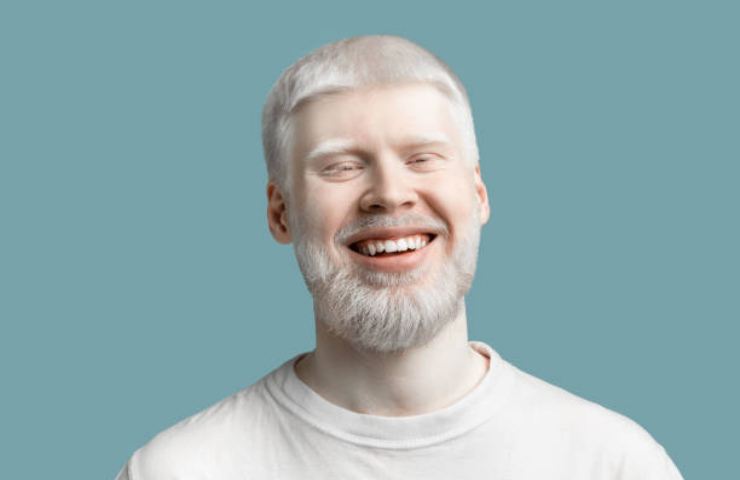 Persona albina
